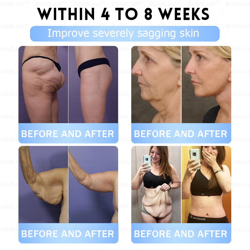 FDA Store |𝐵uil𝗱𝐿ea𝐟® 𝑮𝐋𝑃-1 Slim & Firm 𝑁ano 𝑀icroneedle 𝑃atch with Collagen,Turmeric&Matrixyl 3000 丨Obesity,Cardiovascular Diseas, Diabetes, Sleep Apnea, Joint Problems and More